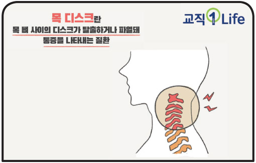 교직1Life 목 디스크란 목 뼈 사이의 디스크가 탈출하거나 파열돼 통증을 나타내는 질환