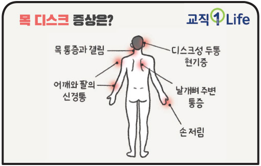 교직1Life 목 디스크 증상은? 목 통증과 결림 어깨와 팔의 신경통 디스크성 두통 현기증 날개뼈 주변 통증 손 저림